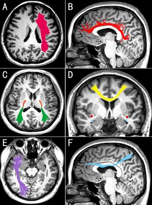 White Matter Alterations in Depressive Disorder